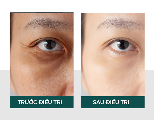 Liệu trình Derma Under Eyes