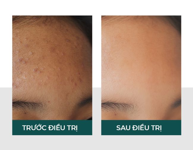 Tình trạng mụn ẩn được cải thiện sau khi sử dụng liệu trình Derma Acne Care