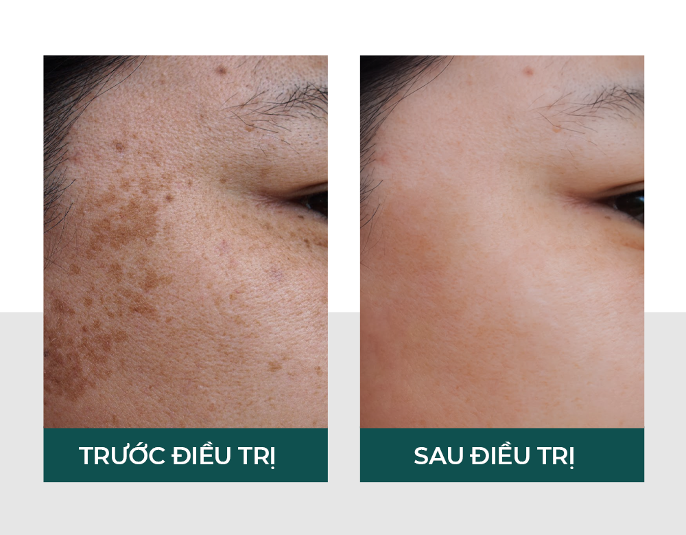 Trước và sau điều trị Laser Skin Health