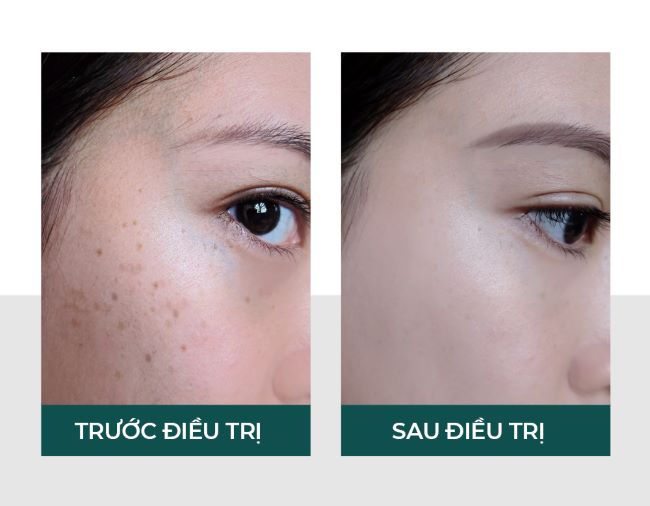 Liệu trình Laser skin health mang lại làn da trắng sáng, mờ thâm