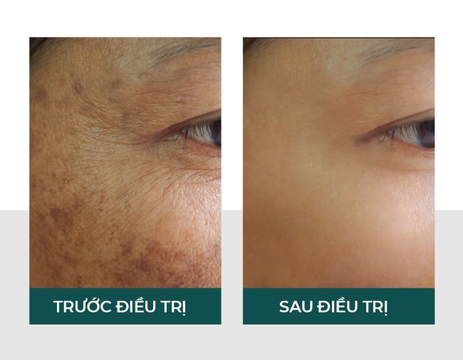 Da được trẻ hóa và hết nám sau liệu trình Derma Bright