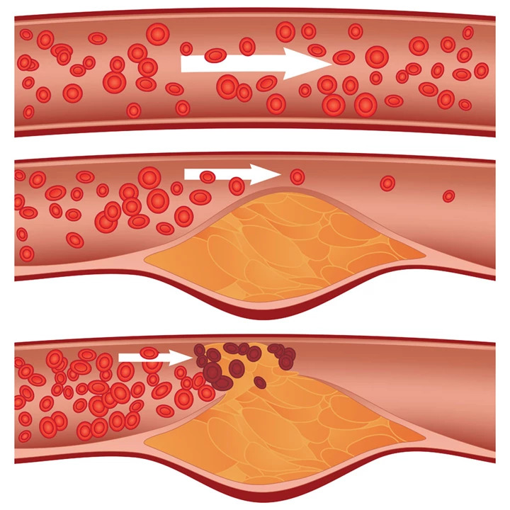 Cholesterol được phân thành cholesterol tốt và cholesterol xấu