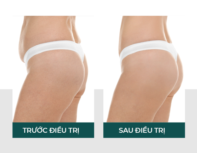 Giảm cân hiệu quả và an toàn với liệu trình Body Sculpt tại VITA Clinic