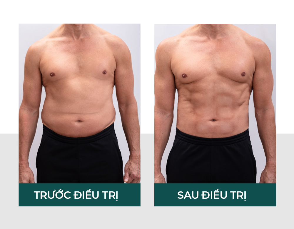 Hình ảnh khách hàng thành công đào thải mỡ bụng sau khi thực hiện liệu trình Body Sculpt