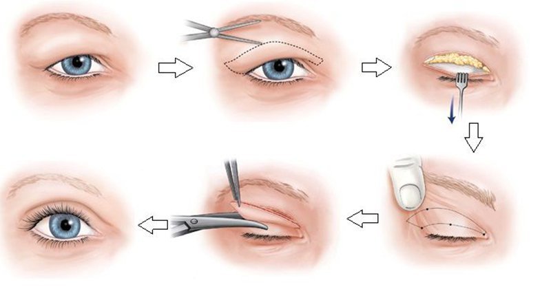  Bạn có thể cắt mí hoặc nhấn mí để khắc phục mắt mí lót