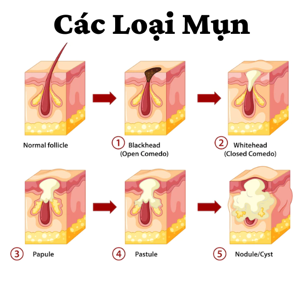 Các loại mụn lưng thường gặp trên lưng