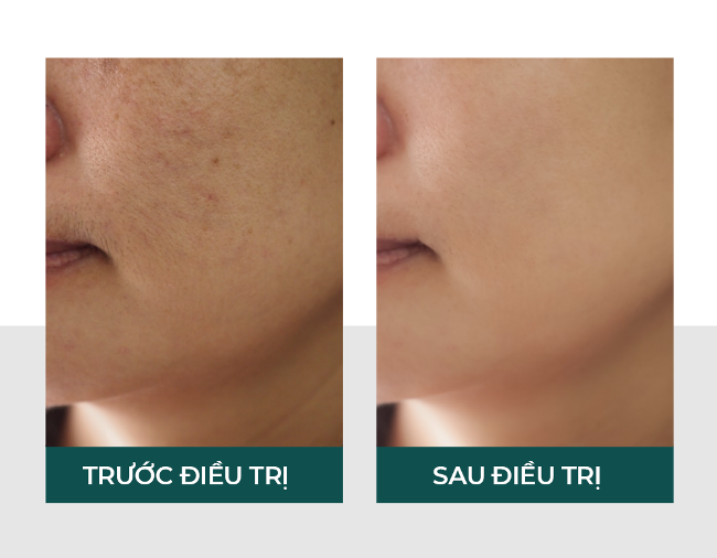 Ngoài tác dụng điều trị mụn thịt, Laser Skin Health còn có khả năng chống lão hóa, nuôi dưỡng da căng mịn