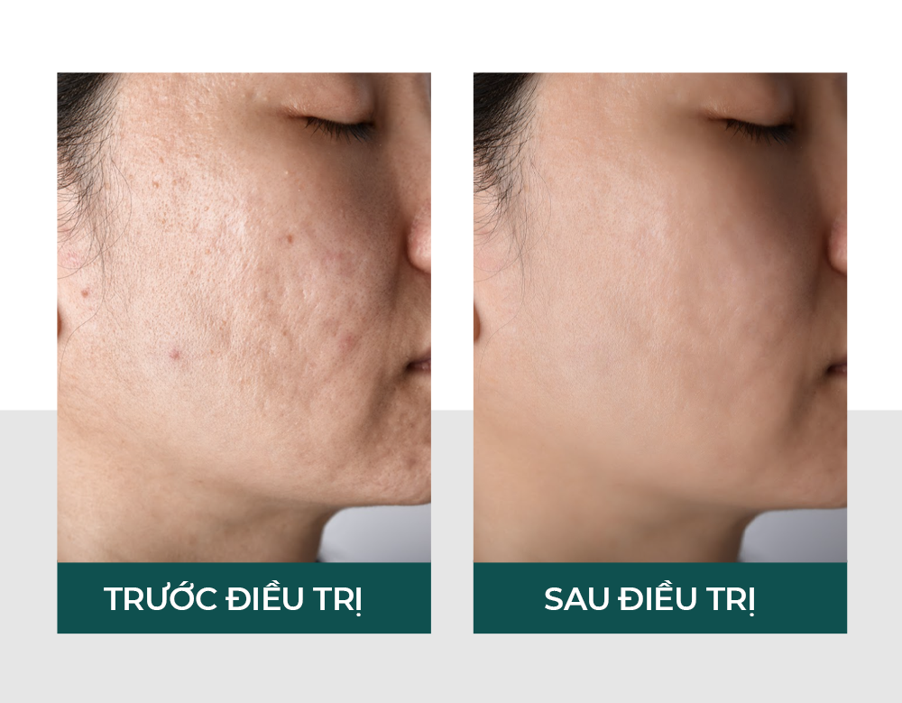VITA Clinic sử dụng công nghệ laser tân tiến từ Châu Âu cải thiện dấu hiệu lão hóa 