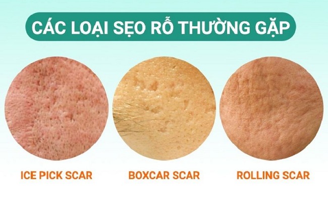 Các loại sẹo thường thấy