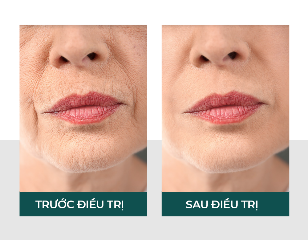 Trước và sau điều trị trẻ hóa tế bào FSC 
