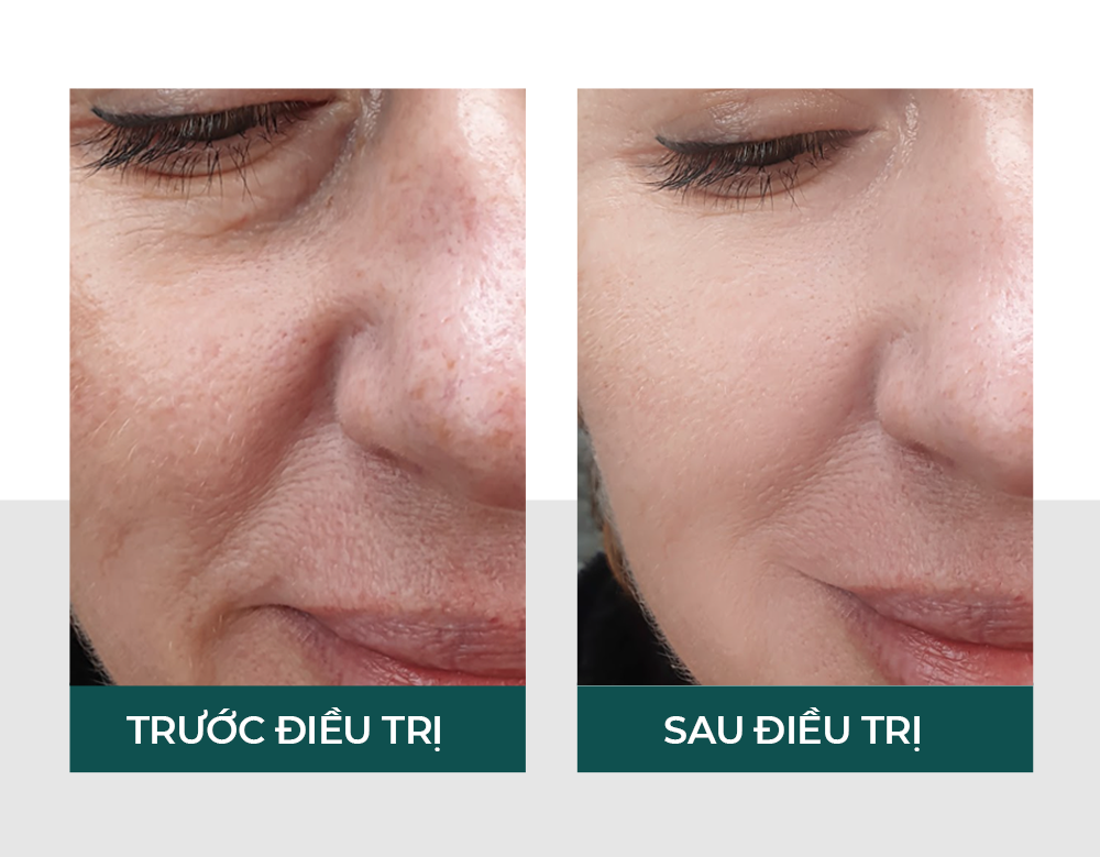 Hiệu quả sau điều trị bằng tế bào gốc