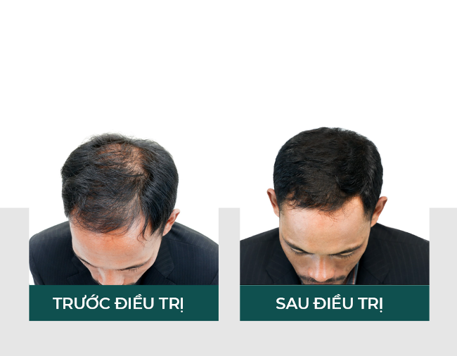 Hiệu quả điều trị rụng tóc bằng liệu trình Derma Hair Loss