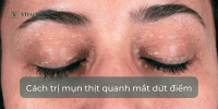 Cách trị mụn thịt quanh mắt dứt điểm và các điều lưu ý | VITA Clinic