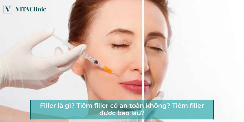 Filler là gì? Tiêm filler có an toàn không? Tiêm filler được bao lâu?