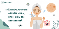Thâm Đỏ Sau Mụn: Nguyên Nhân, Cách Điều Trị Nhanh Nhất - VITA Clinic