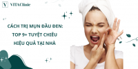 Cách trị mụn đầu đen tại nhà, Nguyên nhân & Cách chăm sóc | VITA Clinic