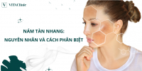 Nám tàn nhang: Nguyên nhân và cách phân biệt - VITA Clinic