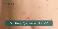 Sẹo thủy đậu bao lâu thì hết?  - VITA Clinic