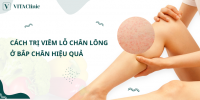 Top 10 cách trị viêm lỗ chân lông ở bắp chân hiệu quả - VITA Clinic