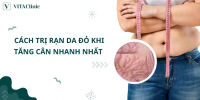 [15+] Cách trị rạn da đỏ khi tăng cân nhanh nhất - VITA Clinic