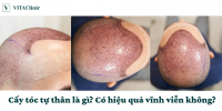 Cấy tóc tự thân là gì? Có hiệu quả vĩnh viễn không? - VITA Clinic