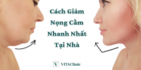 Cách Giảm Nọng Cằm Nhanh Nhất Tại Nhà - VITA Clinic