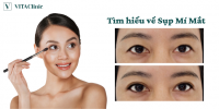 Sụp Mí Mắt: Nguyên nhân, dấu hiệu & cách điều trị - VITA Clinic