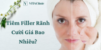 Tiêm Filler rãnh cười giá bao nhiêu? Duy trì trong bao lâu?