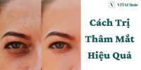 15 Cách trị thâm mắt tại nhà & tại spa hiệu quả nhất 2023 | VITA Clinic