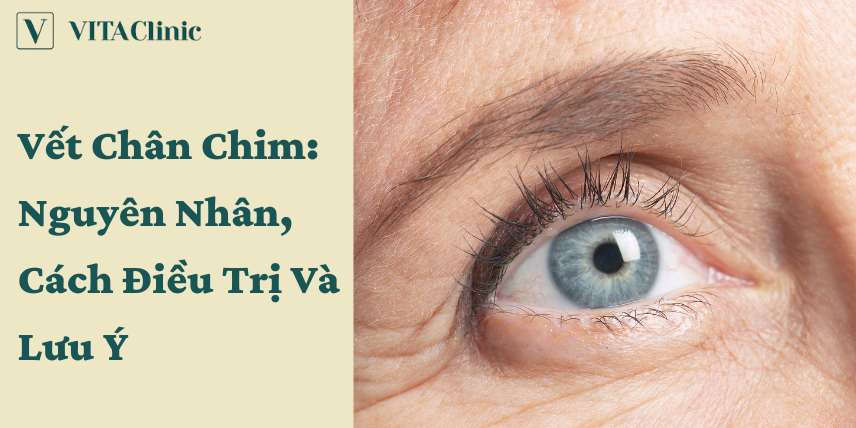 VẾT CHÂN CHIM: Nguyên nhân, cách điều trị và lưu ý - VITA Clinic