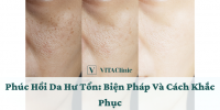 Phục Hồi Da Hư Tổn: Dấu Hiệu Và Các Biện Pháp Phục Hồi - VITA Clinic