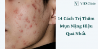 Mách Bạn 14 Cách Trị Thâm Mụn Nặng Cho Mọi Loại Da Tại Nhà | VITA Clinic