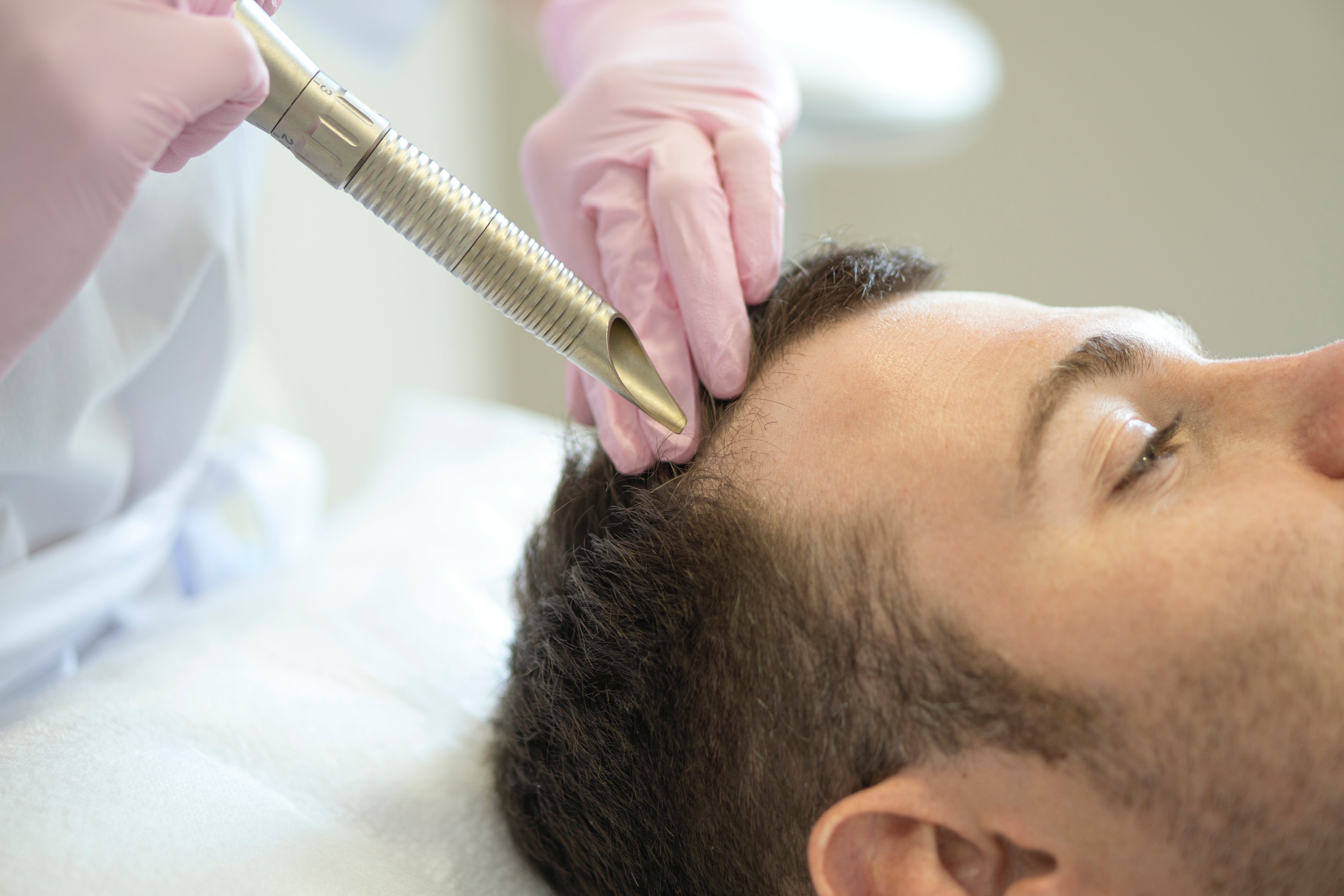 Laser Microneedling Hair